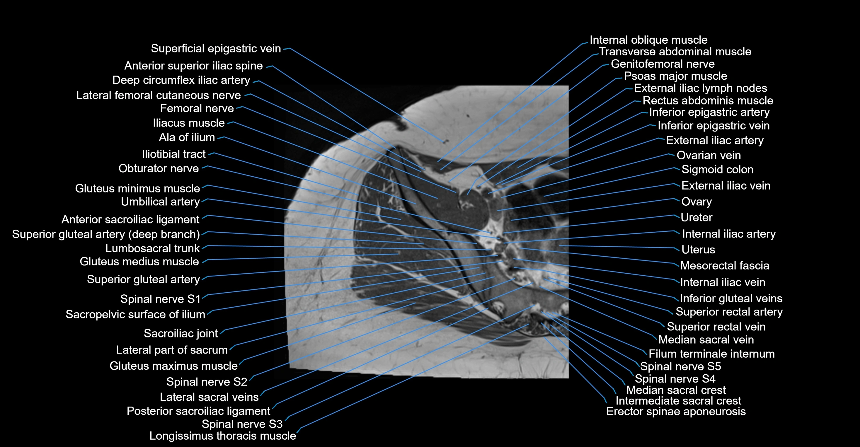 MRI hip axial cross sectional anatomy 3T 3D  radiology  anatomy image-img-00001-00004.webp
